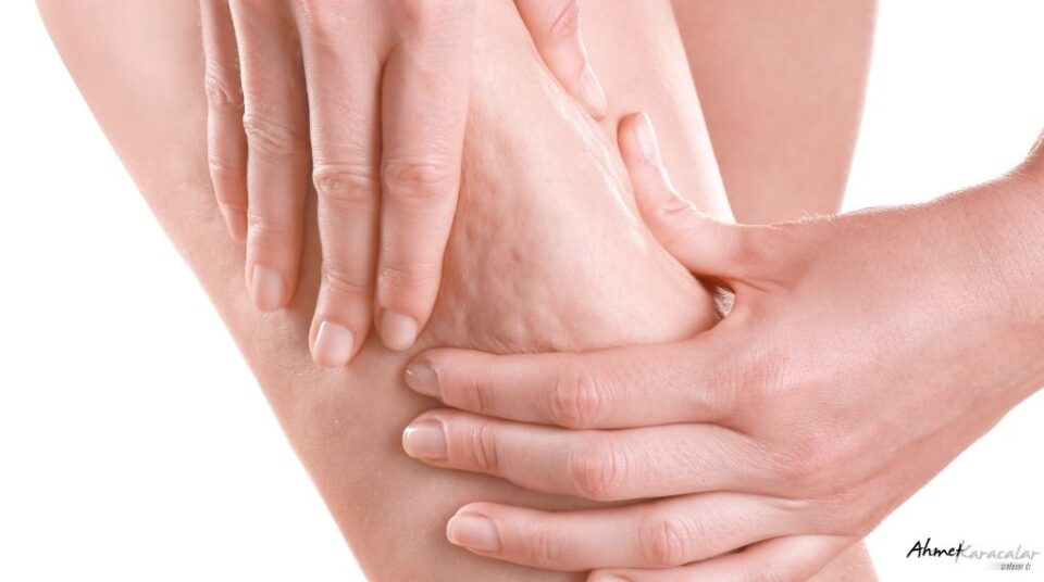 selulit tedavisi 095925851