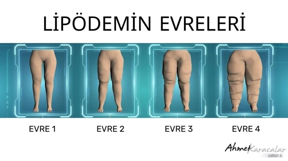 lipodemin evreleri 093511033